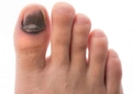 Darbe Sonucu Tırnak Morarması Belirtileri ve Tedavisi Darbe Sonucu Tırnak Morarması Belirtileri ve Tedavisi