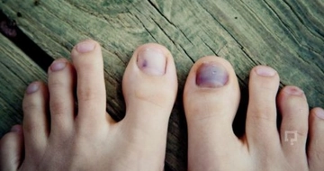 Tırnak Morarmasına Ne İyi Gelir? Tırnak Morarmasına Ne İyi Gelir?